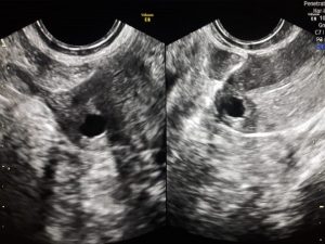 Early pregnancy at right corny of uterus