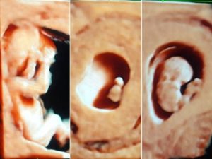 Laparoscopic View of a Tiny Embryo on Ultrasound