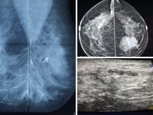 Breast Ultrasound With Mammogram