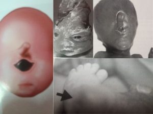 Level 2 scan for Foetal congenital anomalies