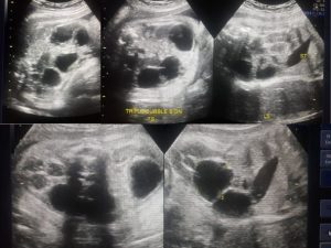 Why third-trimester ultrasound is necessary?