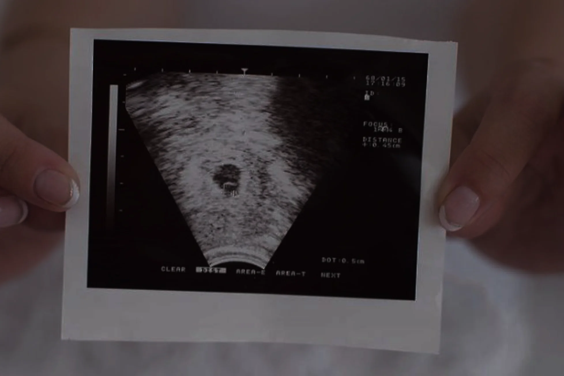 Foetal Echo Cardiography